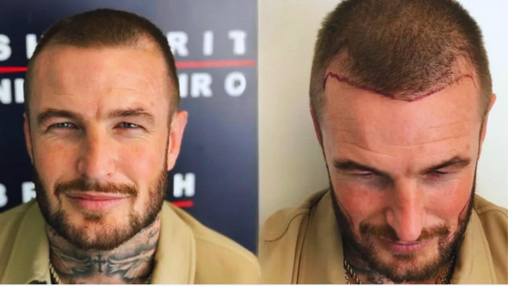 Side-by-side shows man with buzzcut and receding hairline before, then post-transplant with marked hairline and new density.