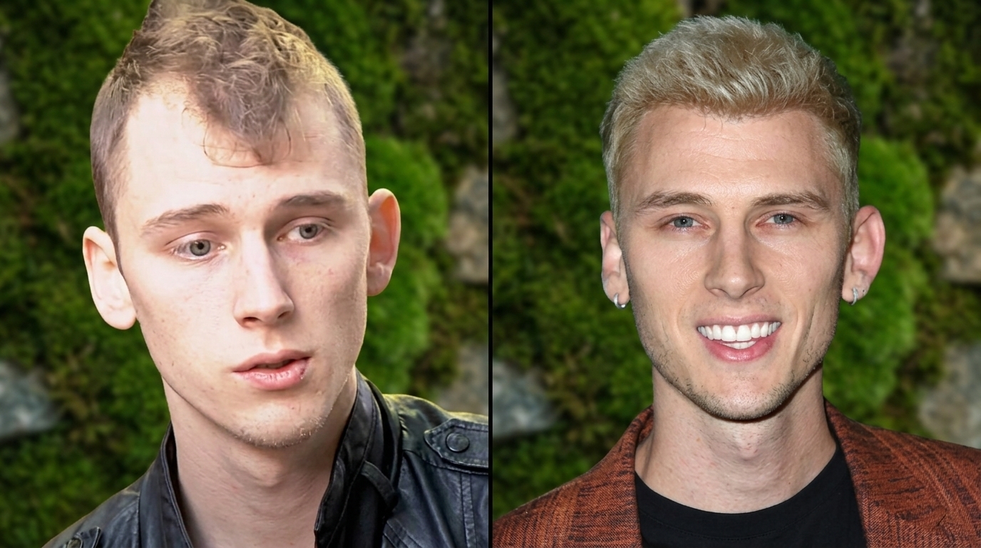 MGK hair transplant before and after showing fuller hair and improved density