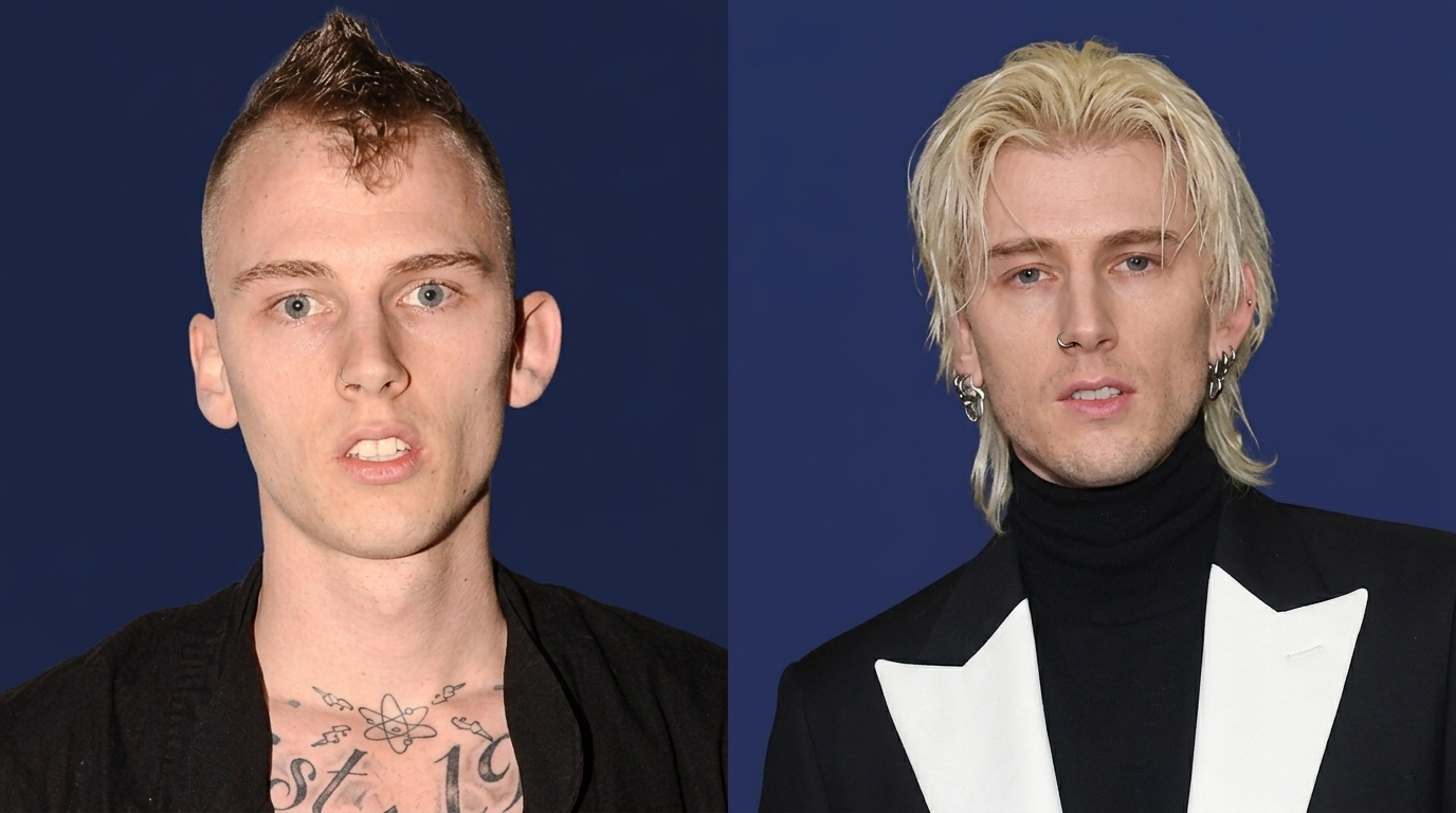 MGK hair transplant before and after comparison showing hairline change
