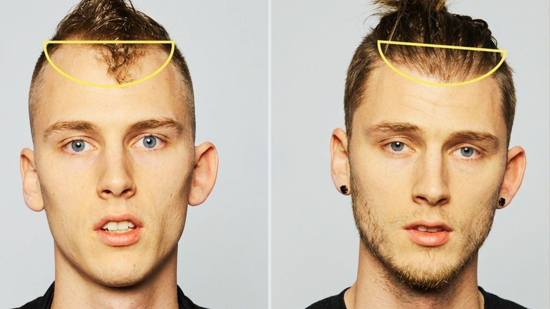 MGK hairline before and after hair transplant marked restoration results